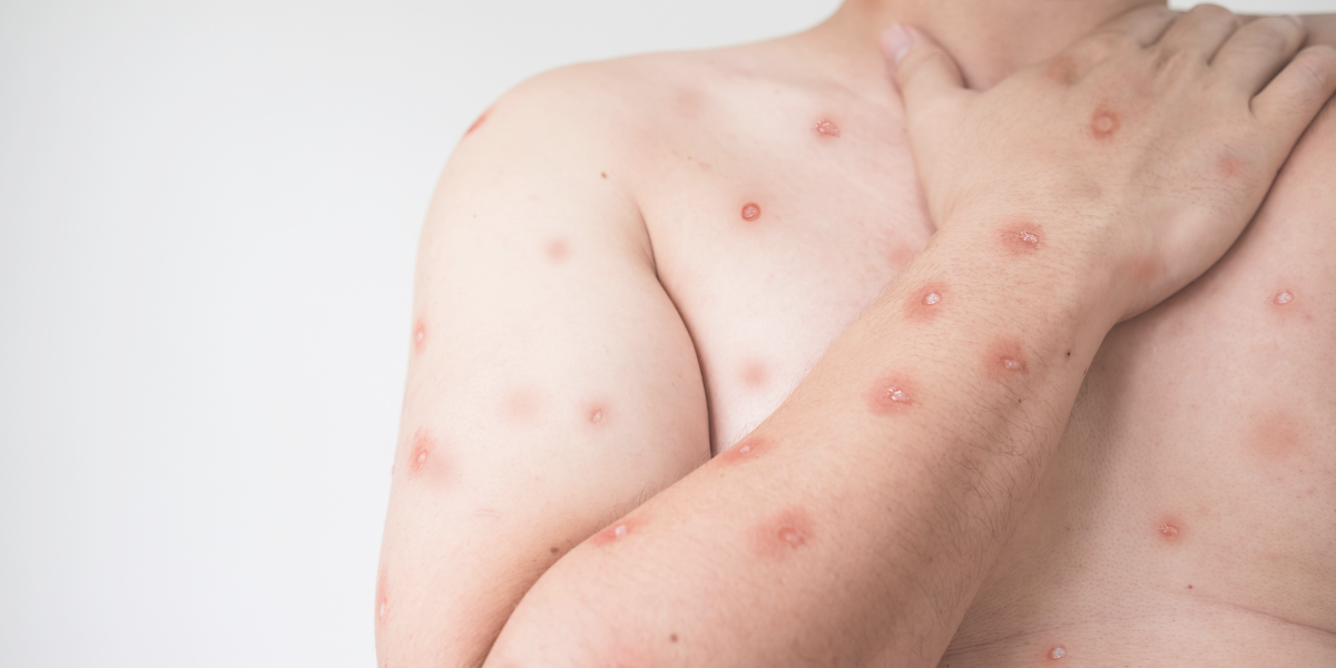 Mpox (Monkeypox): Senarai Simptom dan Rawatan